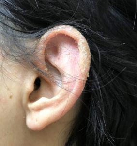 耳の湿疹　左